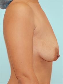 Breast Lift Before Photo by John Anastasatos, MD; Los Angeles, CA - Case 29306