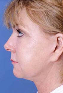 Facelift After Photo by Rod Rohrich, MD, FACS; Dallas, TX - Case 4028