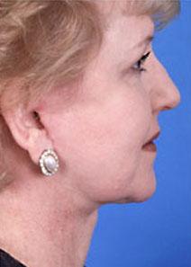 Facelift After Photo by Rod Rohrich, MD, FACS; Dallas, TX - Case 4051