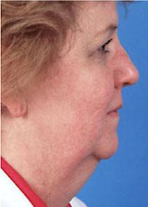 Facelift Before Photo by Rod Rohrich, MD, FACS; Dallas, TX - Case 4051