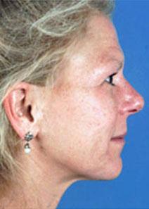 Facelift Before Photo by Rod Rohrich, MD, FACS; Dallas, TX - Case 4064