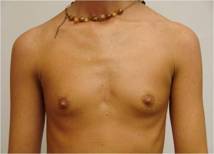 Breast Augmentation Before and After Photos by Walter Erhardt MD