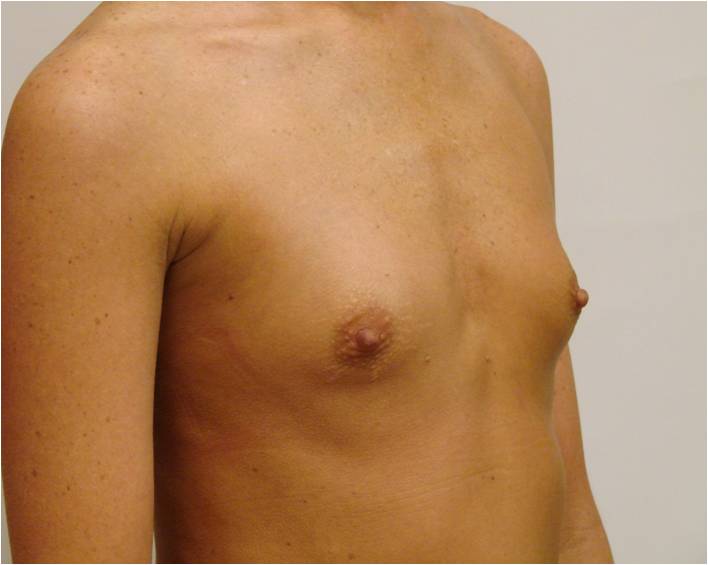 Breast Augmentation Before and After Photos by Walter Erhardt MD