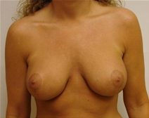 Breast Lift After Photo by Walter Erhardt, MD; Albany, GA - Case 22730