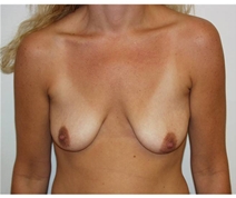 Breast Lift Before Photo by Walter Erhardt, MD; Albany, GA - Case 22730