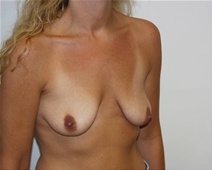 Breast Lift Before Photo by Walter Erhardt, MD; Albany, GA - Case 22730