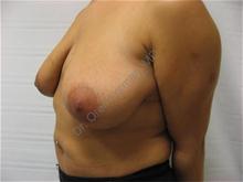 Breast Lift Before Photo by Oren Lerman, MD, FACS; New York, NY - Case 26850