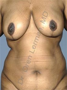 Breast Reduction After Photo by Oren Lerman, MD, FACS; New York, NY - Case 26851 Breast Reduction After Photo by Oren Lerman, MD, FACS; New York, NY - Case 26851