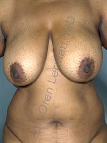 Breast Reduction Before Photo by Oren Lerman, MD, FACS; New York, NY - Case 26851 Breast Reduction Before Photo by Oren Lerman, MD, FACS; New York, NY - Case 26851