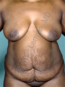 Tummy Tuck Before Photo by Oren Lerman, MD, FACS; New York, NY - Case 26852 Tummy Tuck Before Photo by Oren Lerman, MD, FACS; New York, NY - Case 26852