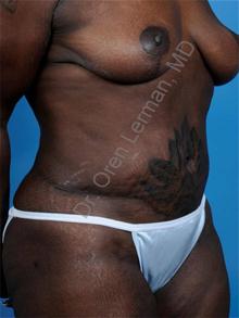 Tummy Tuck After Photo by Oren Lerman, MD, FACS; New York, NY - Case 26852