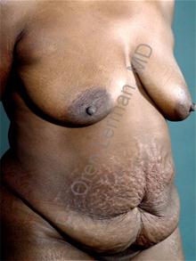 Tummy Tuck Before Photo by Oren Lerman, MD, FACS; New York, NY - Case 26852