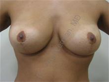 Breast Augmentation After Photo by Oren Lerman, MD, FACS; New York, NY - Case 26853 Breast Augmentation After Photo by Oren Lerman, MD, FACS; New York, NY - Case 26853