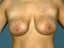 Breast Augmentation Before Photo by Oren Lerman, MD, FACS; New York, NY - Case 26853 Breast Augmentation Before Photo by Oren Lerman, MD, FACS; New York, NY - Case 26853