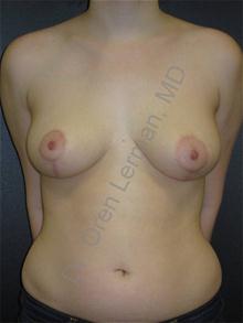 Breast Lift After Photo by Oren Lerman, MD, FACS; New York, NY - Case 26854 Breast Lift After Photo by Oren Lerman, MD, FACS; New York, NY - Case 26854