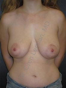 Breast Lift Before Photo by Oren Lerman, MD, FACS; New York, NY - Case 26854 Breast Lift Before Photo by Oren Lerman, MD, FACS; New York, NY - Case 26854