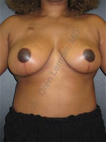 Breast Reduction After Photo by Oren Lerman, MD, FACS; New York, NY - Case 26855 Breast Reduction After Photo by Oren Lerman, MD, FACS; New York, NY - Case 26855