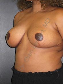 Breast Reduction After Photo by Oren Lerman, MD, FACS; New York, NY - Case 26855