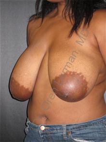 Breast Reduction Before Photo by Oren Lerman, MD, FACS; New York, NY - Case 26855