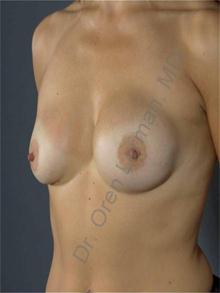 Breast Augmentation Before Photo by Oren Lerman, MD, FACS; New York, NY - Case 26856