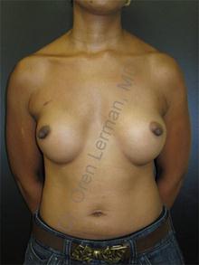 Breast Reconstruction After Photo by Oren Lerman, MD, FACS; New York, NY - Case 26857 Breast Reconstruction After Photo by Oren Lerman, MD, FACS; New York, NY - Case 26857