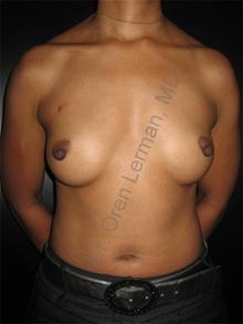 Breast Reconstruction Before Photo by Oren Lerman, MD, FACS; New York, NY - Case 26857 Breast Reconstruction Before Photo by Oren Lerman, MD, FACS; New York, NY - Case 26857