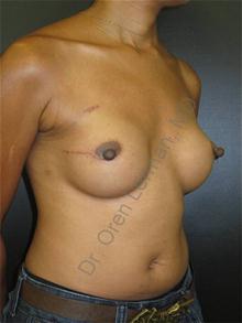 Breast Reconstruction After Photo by Oren Lerman, MD, FACS; New York, NY - Case 26857
