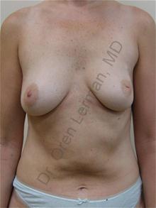 Breast Reconstruction Before Photo by Oren Lerman, MD, FACS; New York, NY - Case 26858 Breast Reconstruction Before Photo by Oren Lerman, MD, FACS; New York, NY - Case 26858