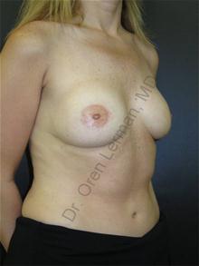 Breast Reconstruction After Photo by Oren Lerman, MD, FACS; New York, NY - Case 26858