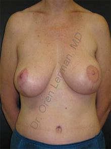 Breast Reconstruction After Photo by Oren Lerman, MD, FACS; New York, NY - Case 26859 Breast Reconstruction After Photo by Oren Lerman, MD, FACS; New York, NY - Case 26859