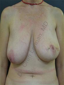 Breast Reconstruction Before Photo by Oren Lerman, MD, FACS; New York, NY - Case 26859 Breast Reconstruction Before Photo by Oren Lerman, MD, FACS; New York, NY - Case 26859