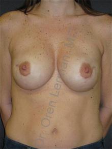 Breast Reconstruction After Photo by Oren Lerman, MD, FACS; New York, NY - Case 26860 Breast Reconstruction After Photo by Oren Lerman, MD, FACS; New York, NY - Case 26860