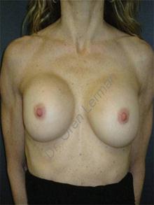Breast Reconstruction Before Photo by Oren Lerman, MD, FACS; New York, NY - Case 26862 Breast Reconstruction Before Photo by Oren Lerman, MD, FACS; New York, NY - Case 26862