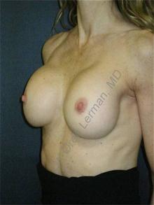 Breast Reconstruction Before Photo by Oren Lerman, MD, FACS; New York, NY - Case 26862