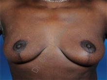 Breast Lift After Photo by Oren Lerman, MD, FACS; New York, NY - Case 26863 Breast Lift After Photo by Oren Lerman, MD, FACS; New York, NY - Case 26863