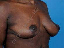 Breast Lift After Photo by Oren Lerman, MD, FACS; New York, NY - Case 26863