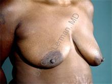 Breast Lift Before Photo by Oren Lerman, MD, FACS; New York, NY - Case 26863