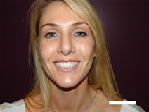 Rhinoplasty After Photo by Moneer Jaibaji, MD; Coronado, CA - Case 20274