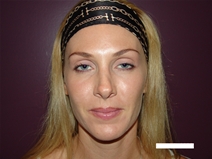 Rhinoplasty Before Photo by Moneer Jaibaji, MD; Coronado, CA - Case 20274