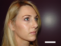 Rhinoplasty After Photo by Moneer Jaibaji, MD; Coronado, CA - Case 20274