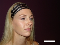 Rhinoplasty Before Photo by Moneer Jaibaji, MD; Coronado, CA - Case 20274