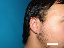 Ear Surgery After Photo by Moneer Jaibaji, MD; Coronado, CA - Case 20275