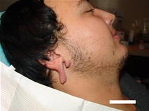 Ear Surgery Before Photo by Moneer Jaibaji, MD; Coronado, CA - Case 20275