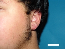 Ear Surgery After Photo by Moneer Jaibaji, MD; Coronado, CA - Case 20275