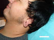 Ear Surgery Before Photo by Moneer Jaibaji, MD; Coronado, CA - Case 20275