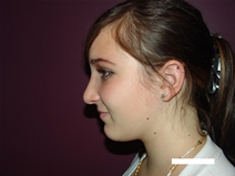 Rhinoplasty After Photo by Moneer Jaibaji, MD; Coronado, CA - Case 20280