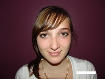 Rhinoplasty After Photo by Moneer Jaibaji, MD; Coronado, CA - Case 20280