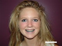 Rhinoplasty After Photo by Moneer Jaibaji, MD; Coronado, CA - Case 20282