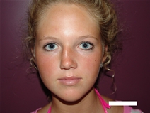Rhinoplasty Before Photo by Moneer Jaibaji, MD; Coronado, CA - Case 20282