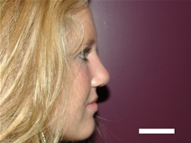 Rhinoplasty After Photo by Moneer Jaibaji, MD; Coronado, CA - Case 20282